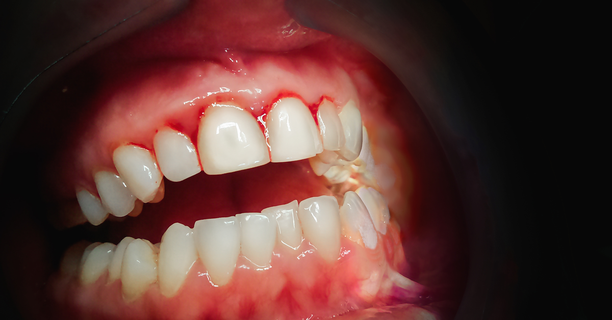 What can be the Cause of Increased Bruising in This Patient?