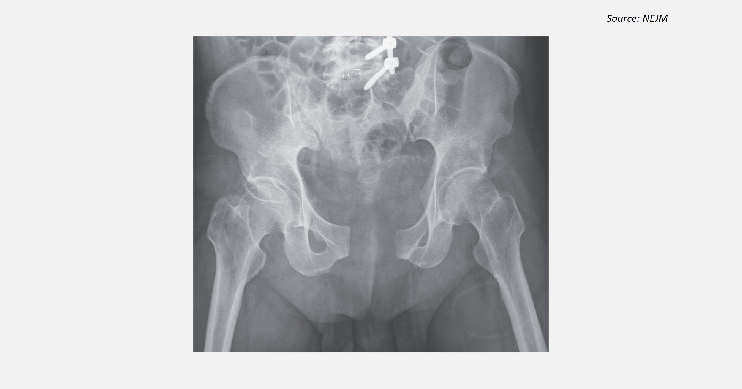 A Case of Widened Pubic Symphysis After an Accident