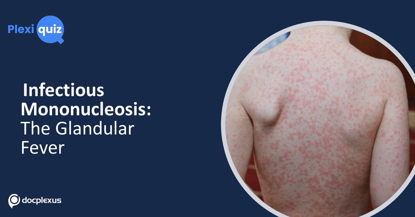A Short Quiz on Infectious Mononucleosis