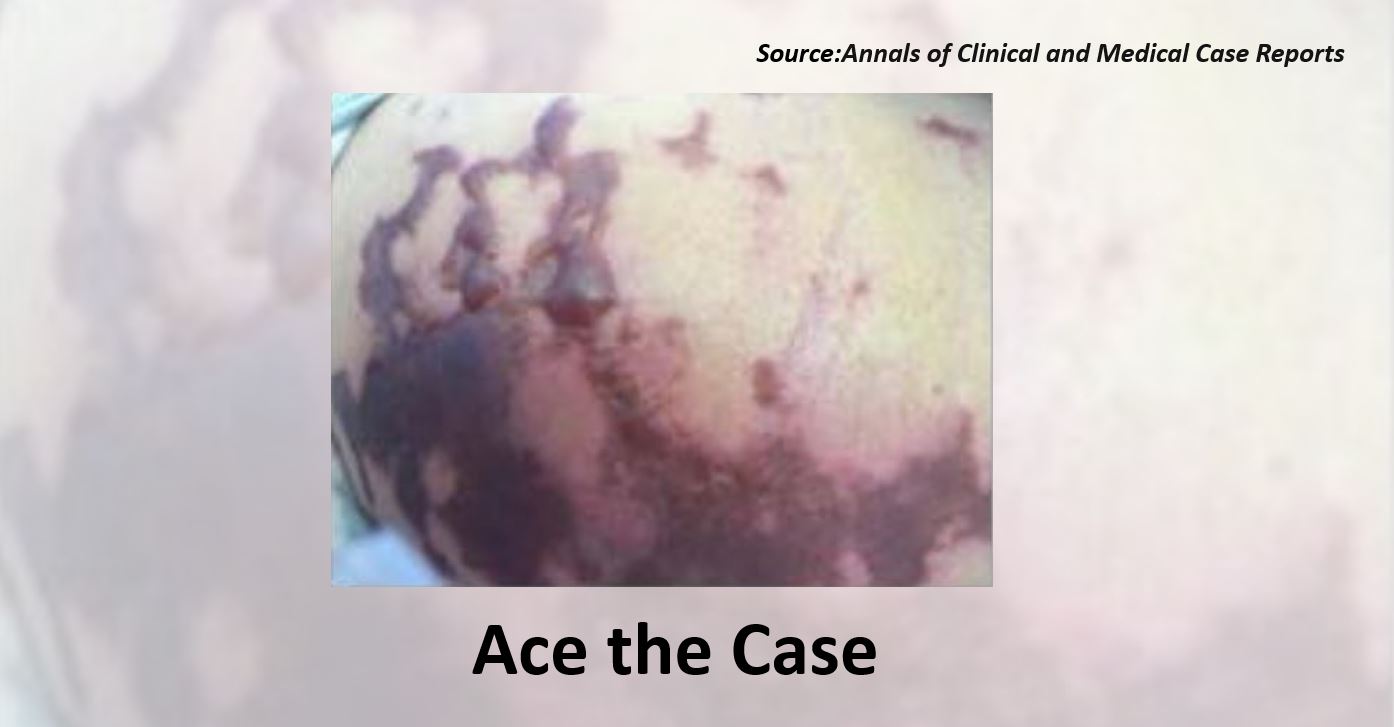 A Case of Swelling and Skin Lesions on the Lower Limb – What’s Your Diagnosis ?