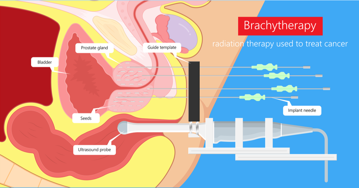 Brachytherapy for Cervical Cancer Treatment