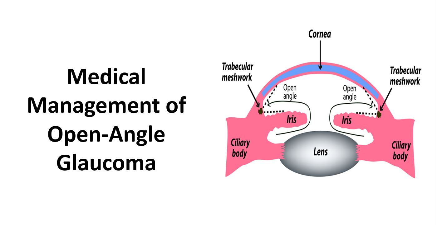AAO 2020: Medical Management Guidelines for Primary Open-Angle Glaucoma