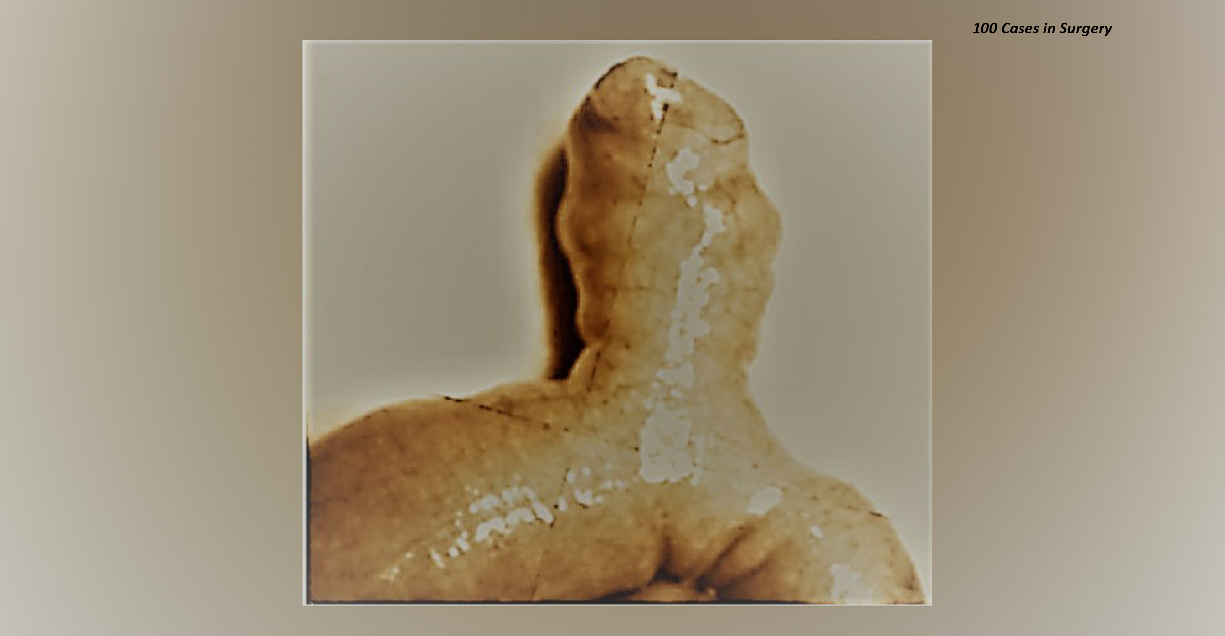 A Boy With Small-Bowel Anomaly