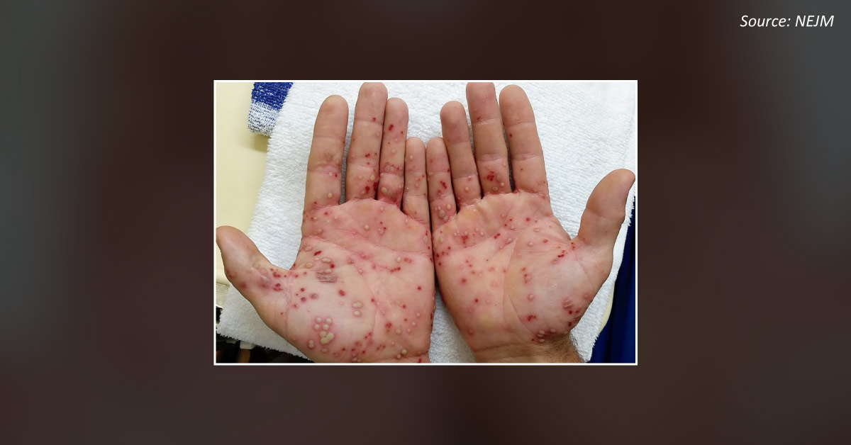 Man with Pustular Rash on Both Hands