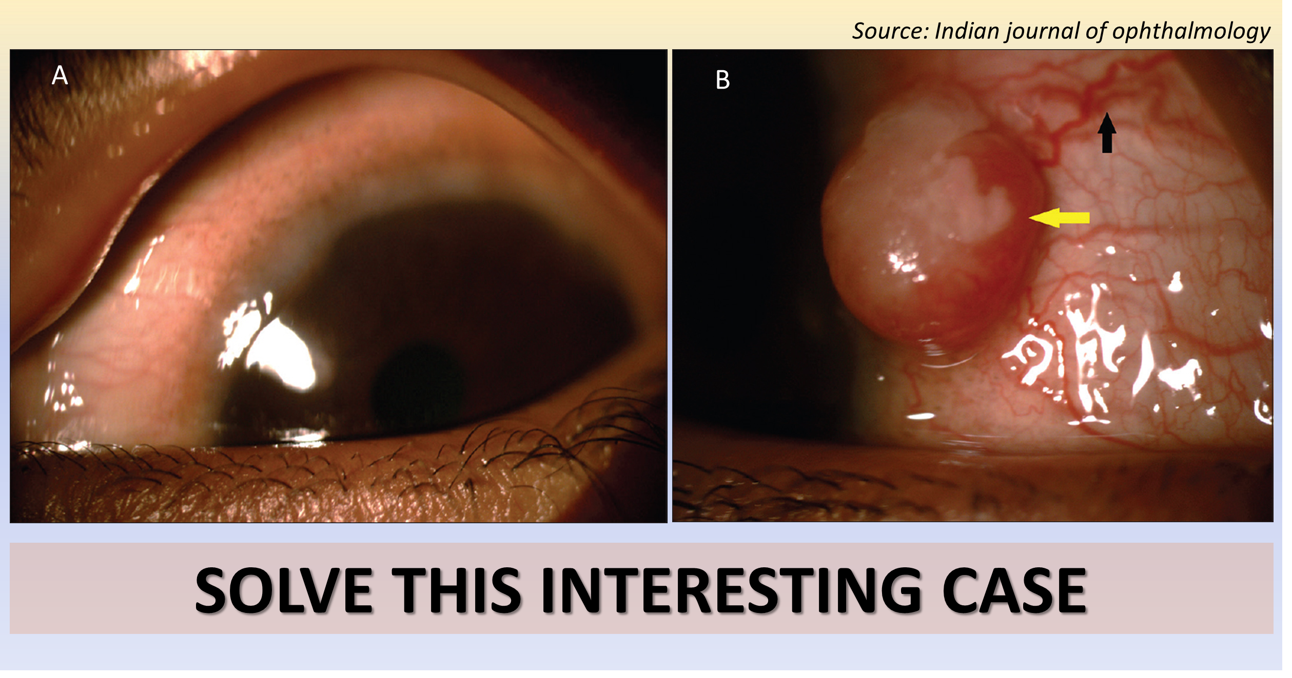 Solve This Case of a Young Girl with a Reddish Mass in Her Eye