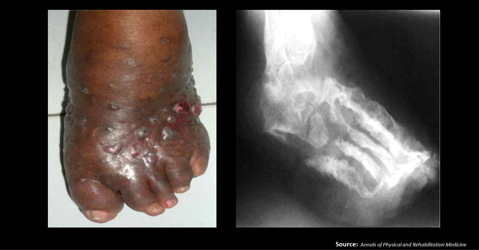 A Case of Painless Swelling in the Foot