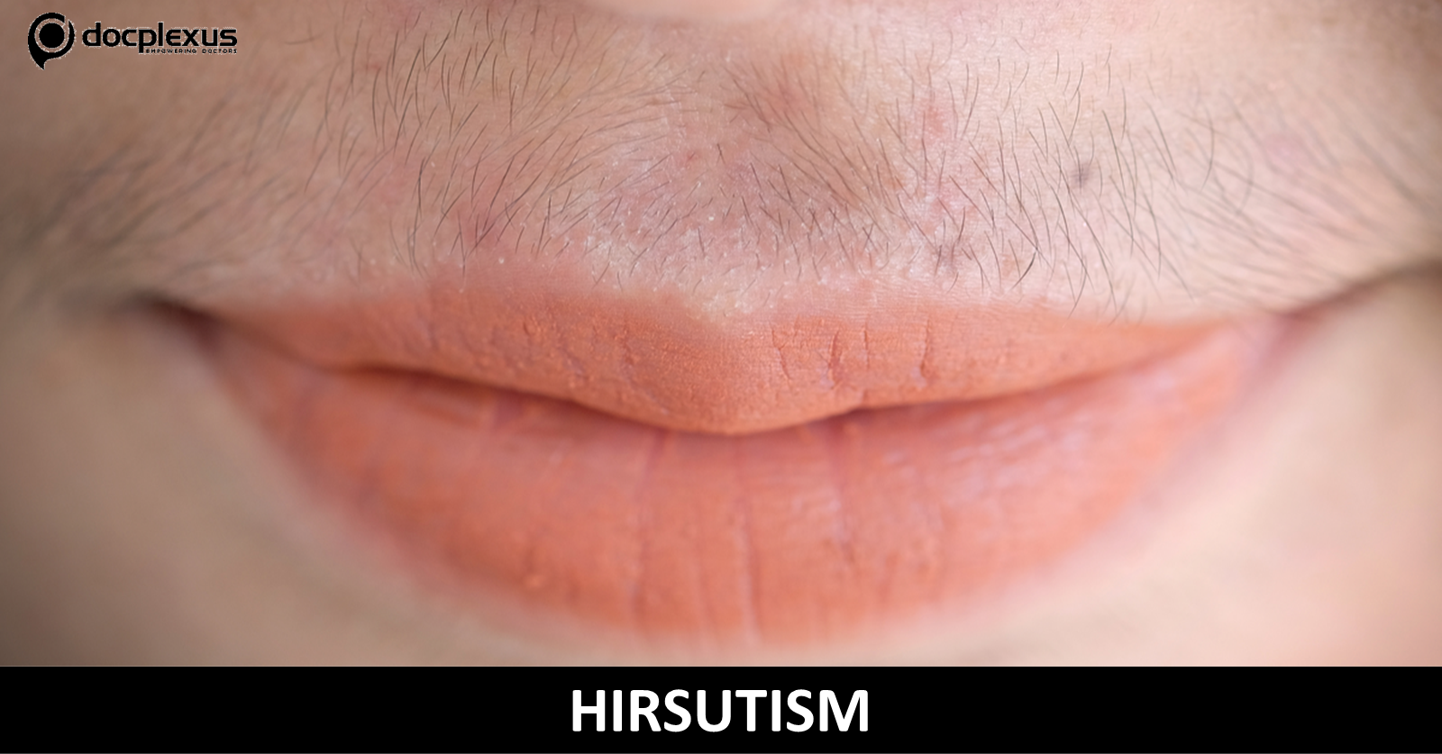 Clinical Scoring in Hirsutism