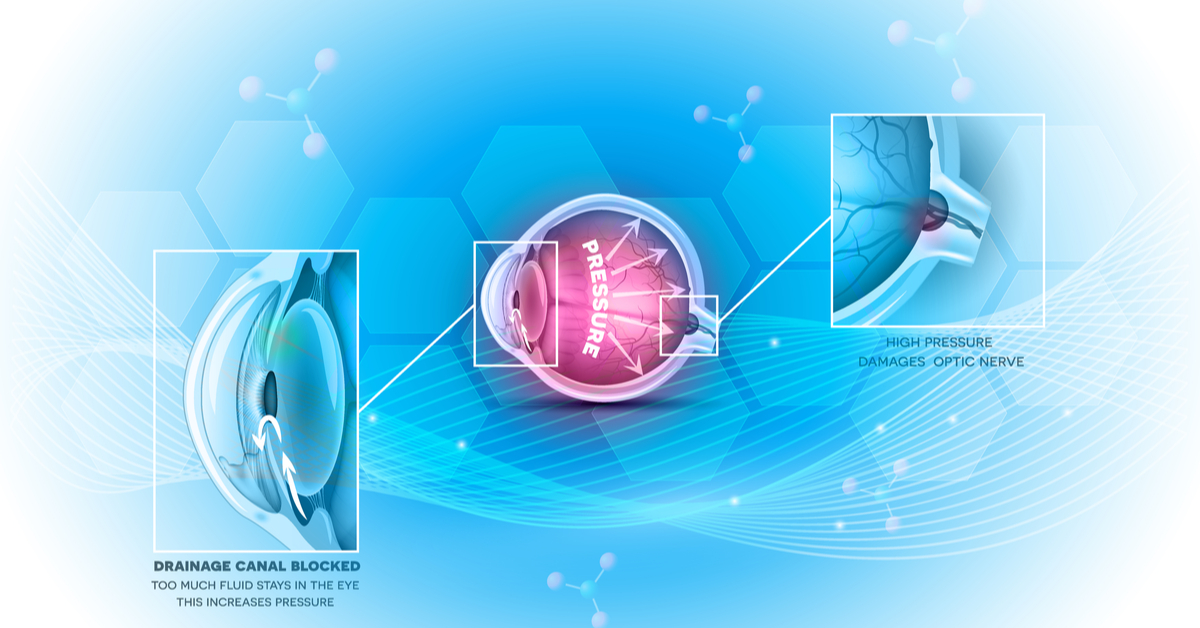 A Quick Test on Angle-closure Glaucoma