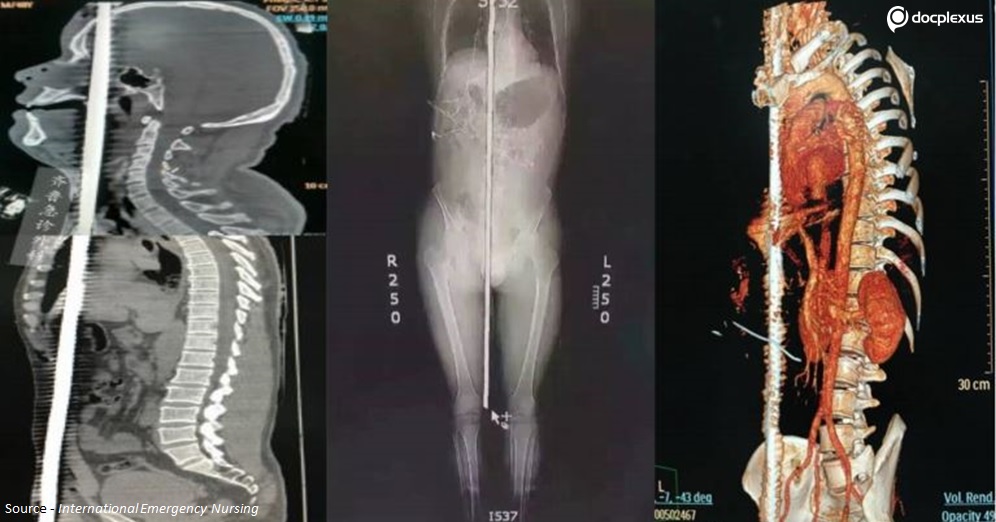 A Man Who Survived Penetration with Rebar