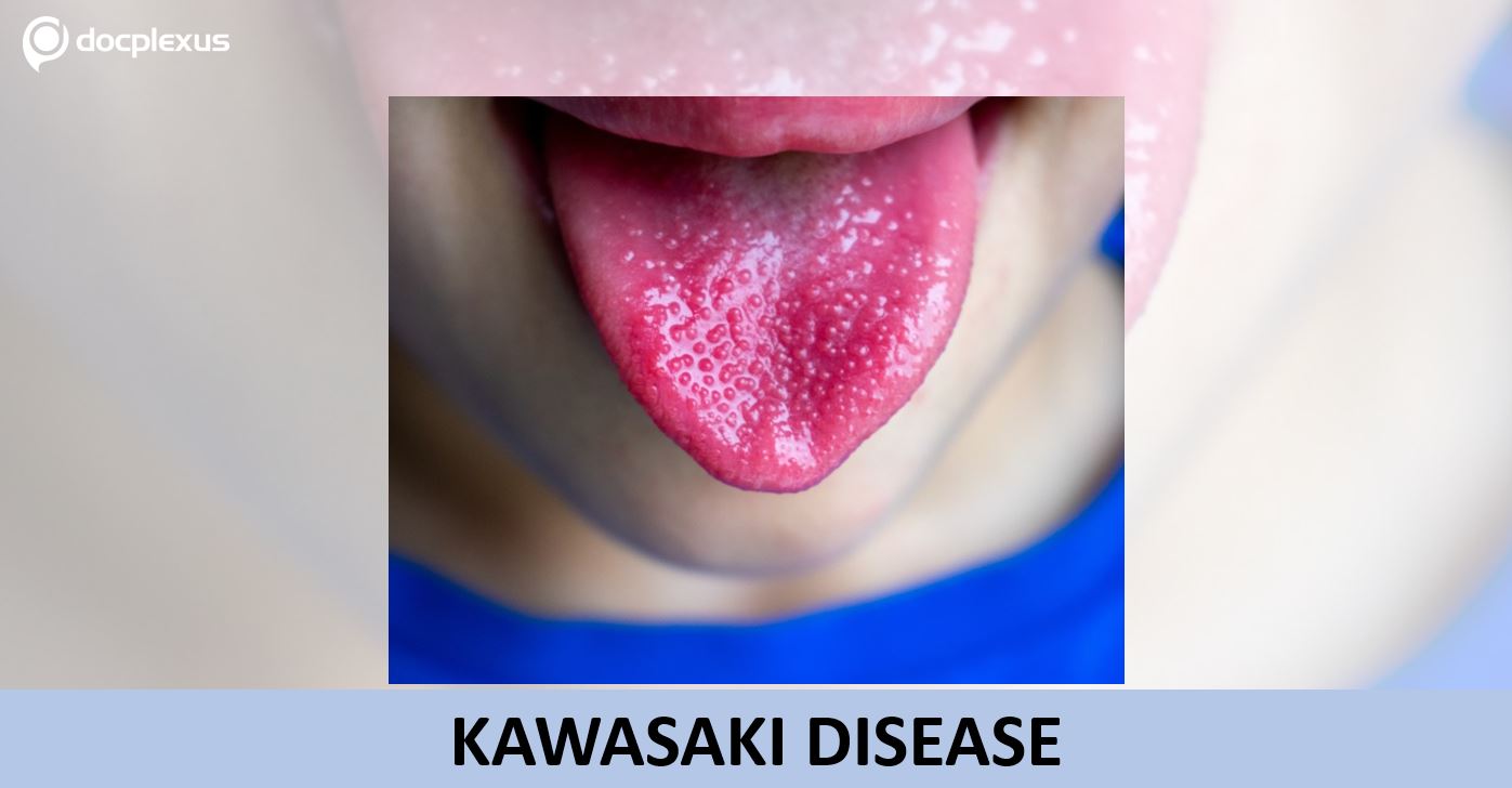 Kawasaki disease - A Rare Complication of COVID-19