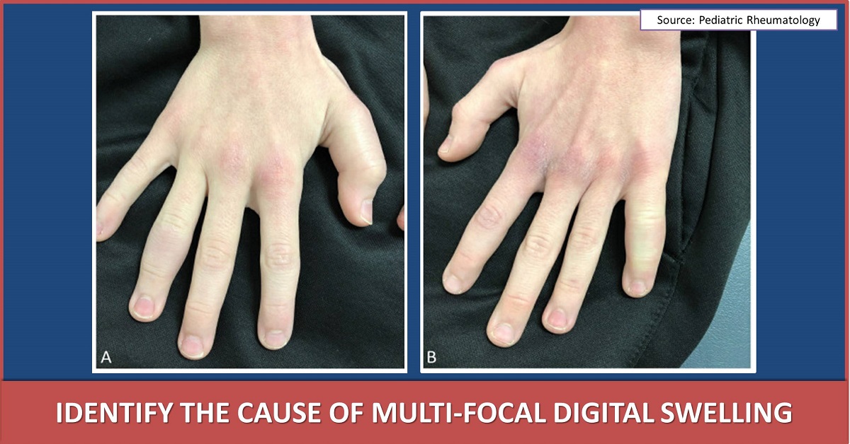 Can You Identify the Cause of Multi-focal Digital Swelling?