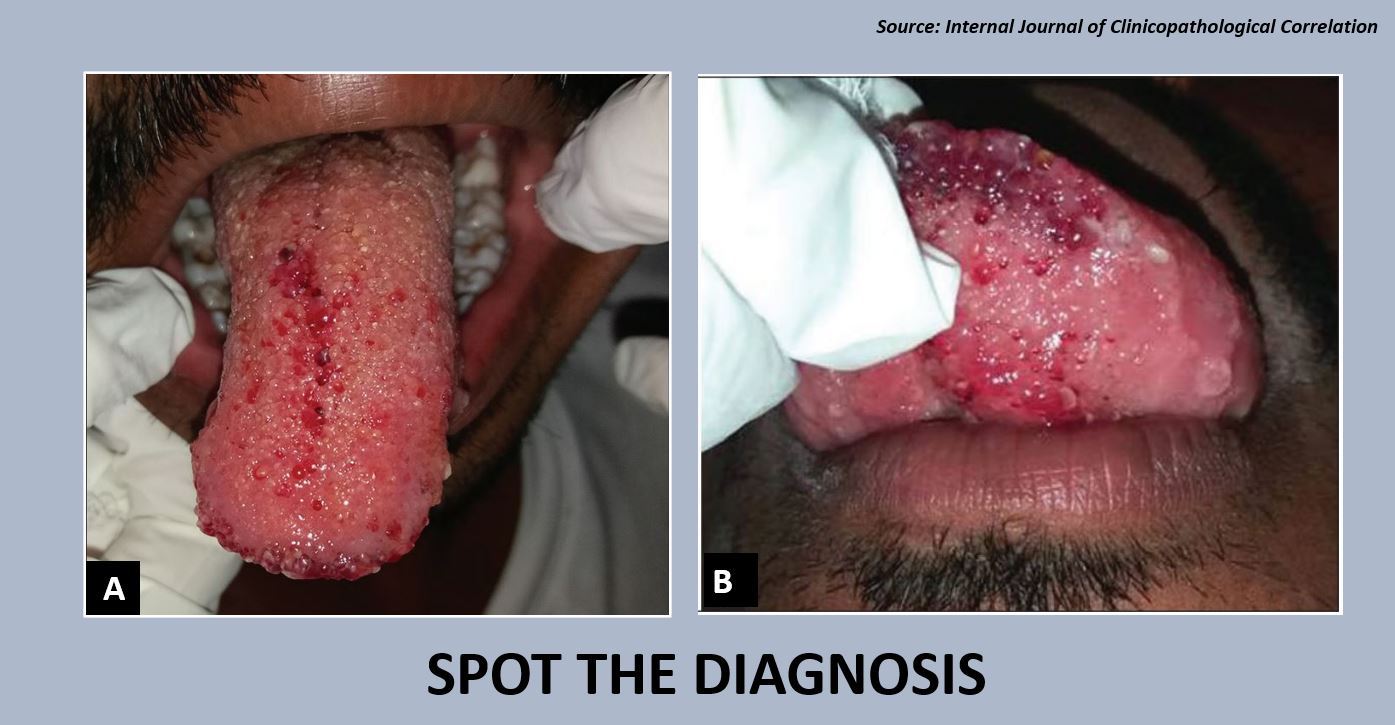 Reddish Spots on the Tongue- What’s Your Diagnosis?