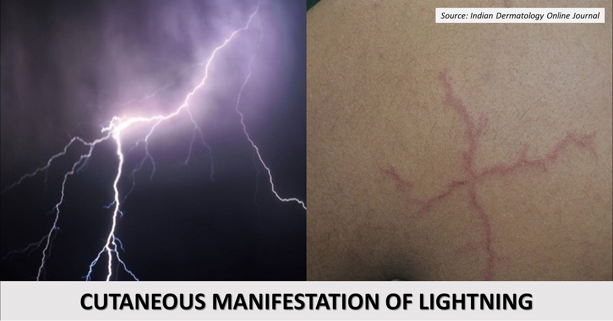 What Are the Cutaneous Manifestation of Lightning Called?