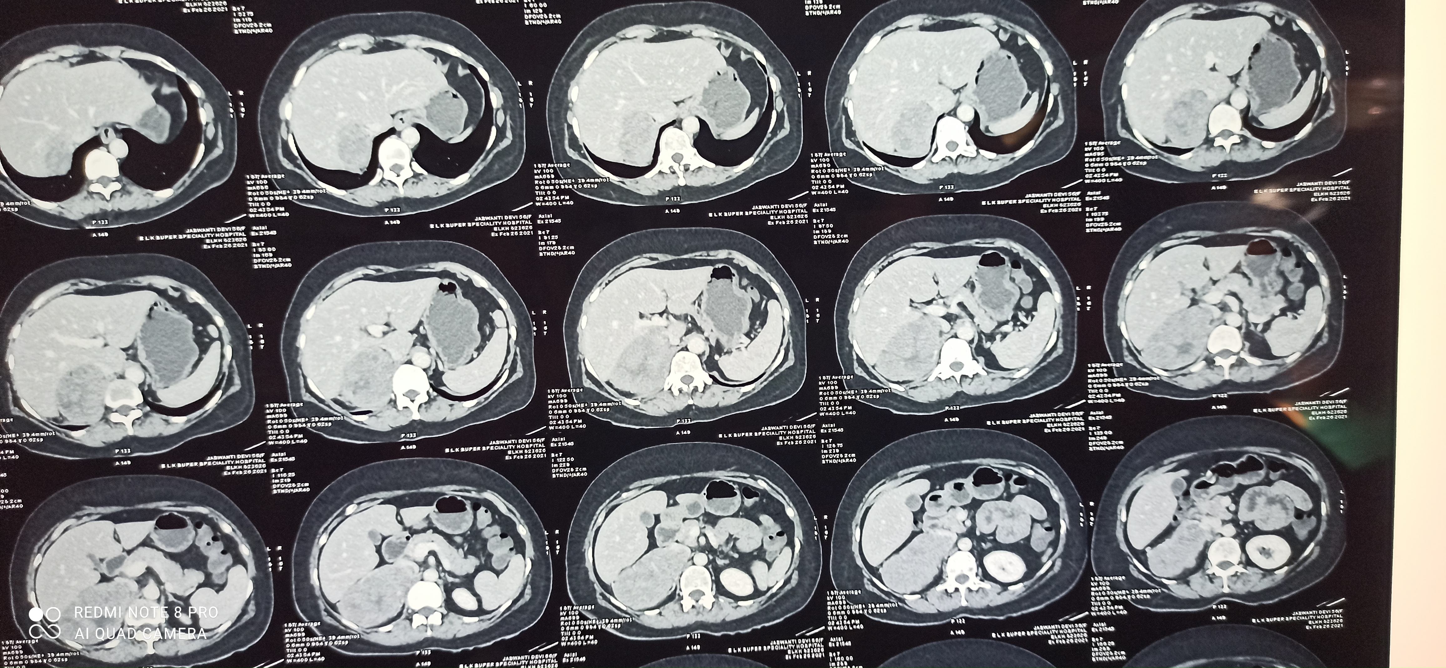 Large Adrenal Mass With IVC Thrombosis