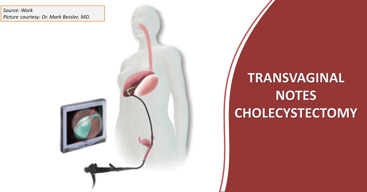 Transvaginal Natural Orifice Transluminal Endoscopic Surgery (NOTES) Cholecystectomy