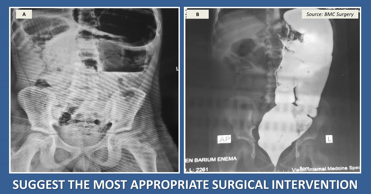 A Pediatric Case of Sigmoid Volvulus