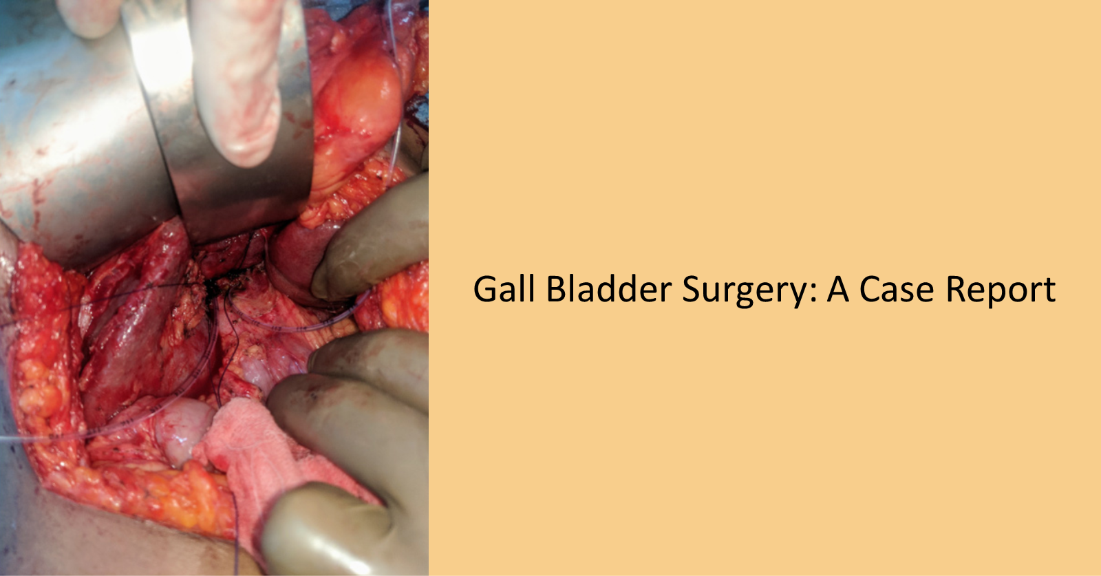 A Gall Bladder Surgery: Is It Routine Surgery?