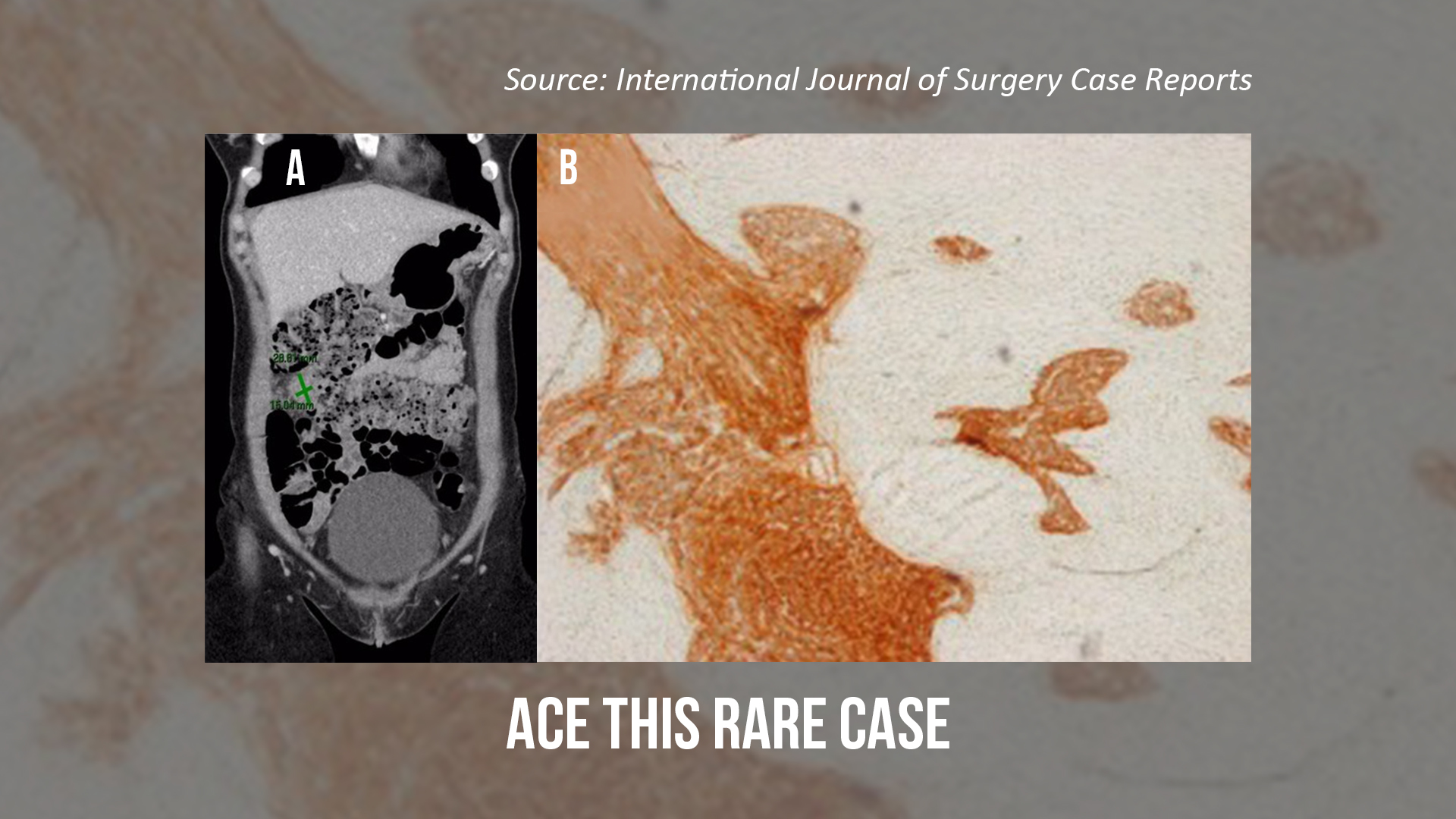 Case of a Woman with Severe Abdominal Pain