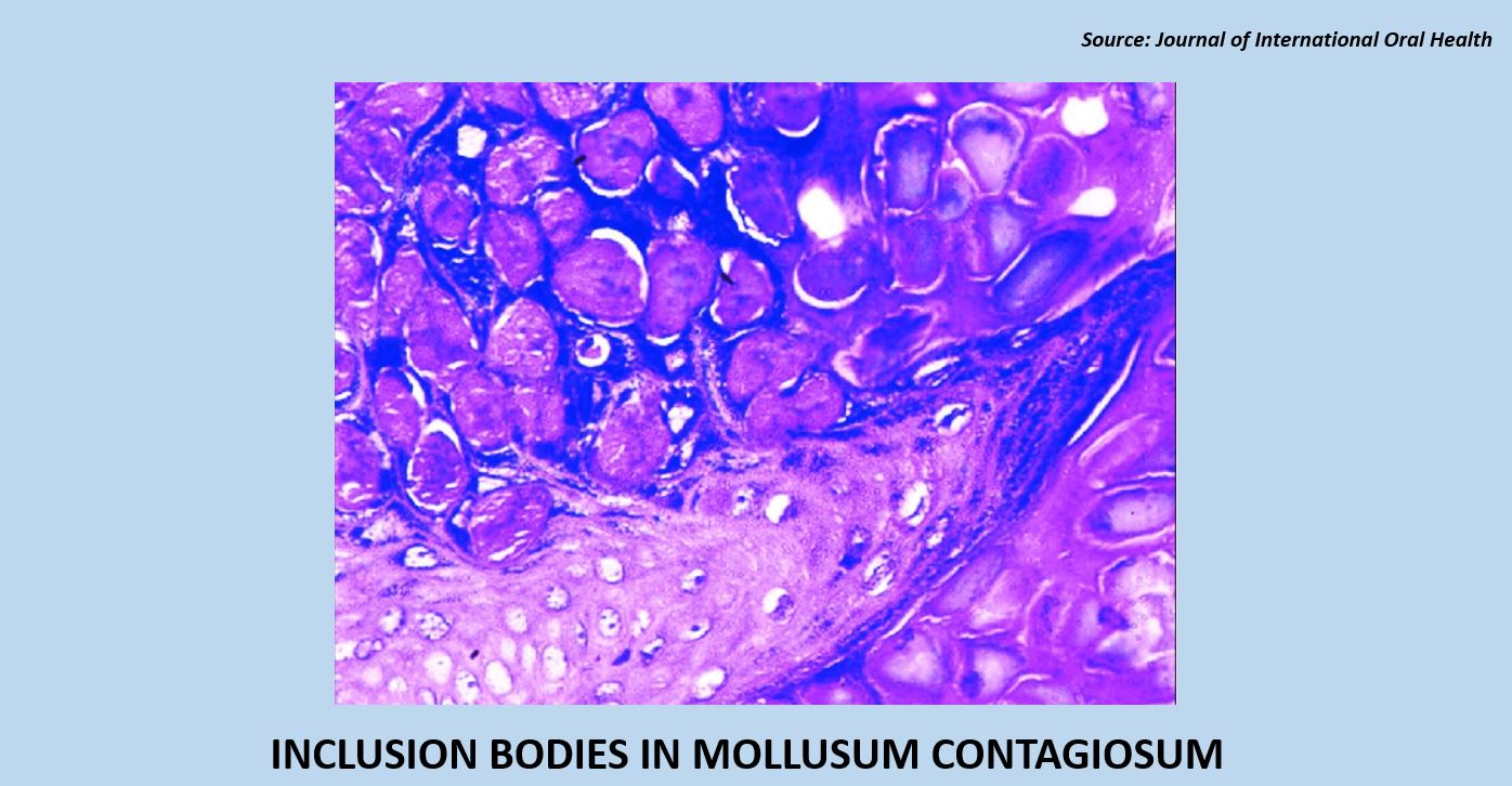 Answer This Question on Molluscum Contagiosum