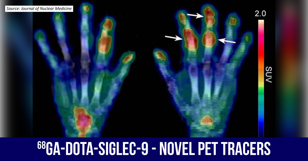 Promising PET Tracers for Early Rheumatoid Arthritis