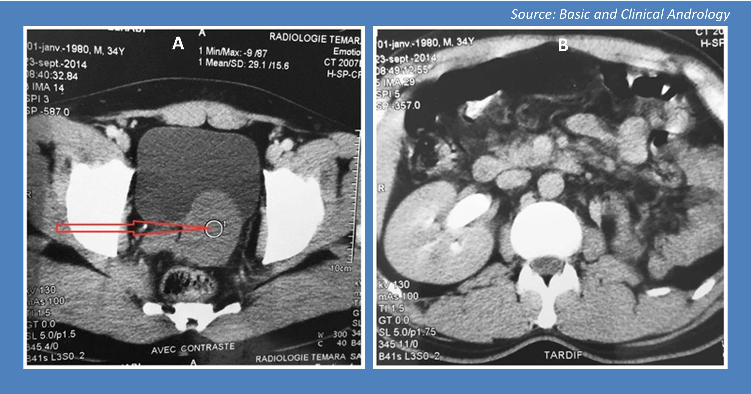 Ace This Case of a Man with Retrovesicular Fluid-filled Mass