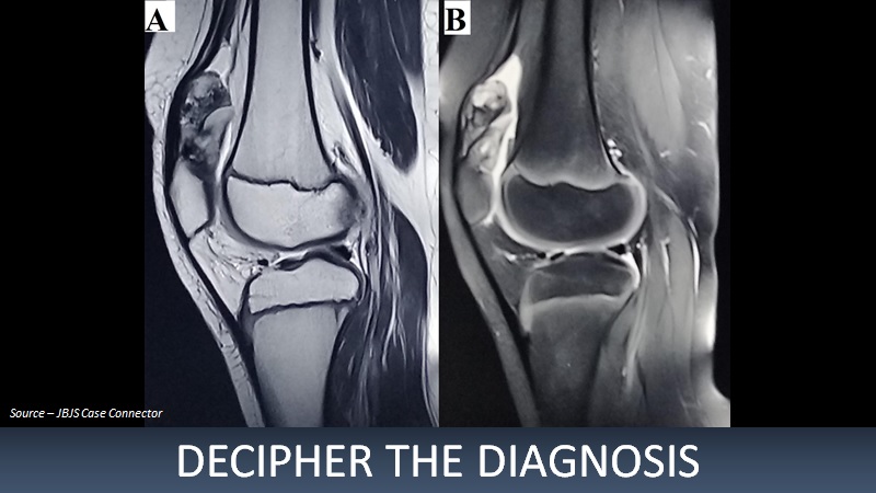 Identify the Reason Behind Swelling in the Knee