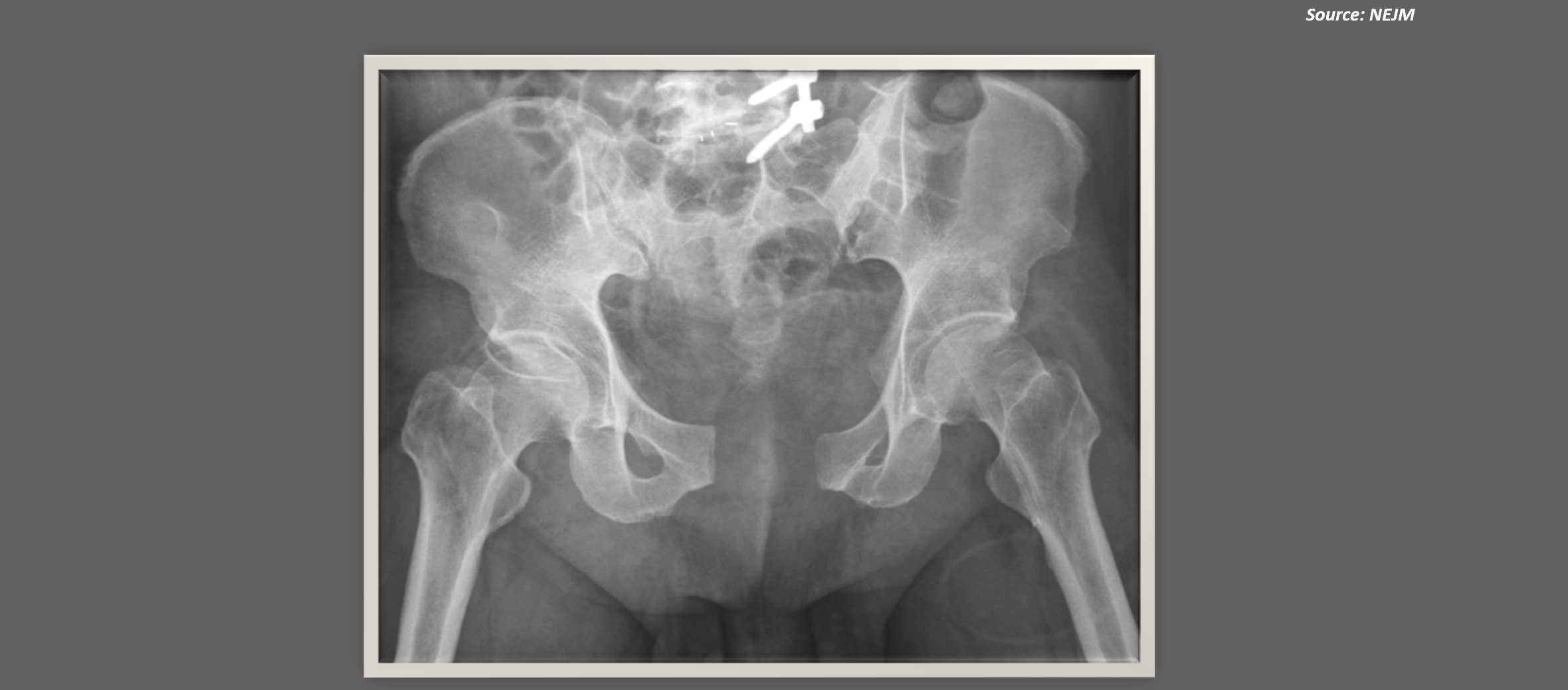 Manage This Patient With Pain in the Anterior and Posterior Pelvic Areas