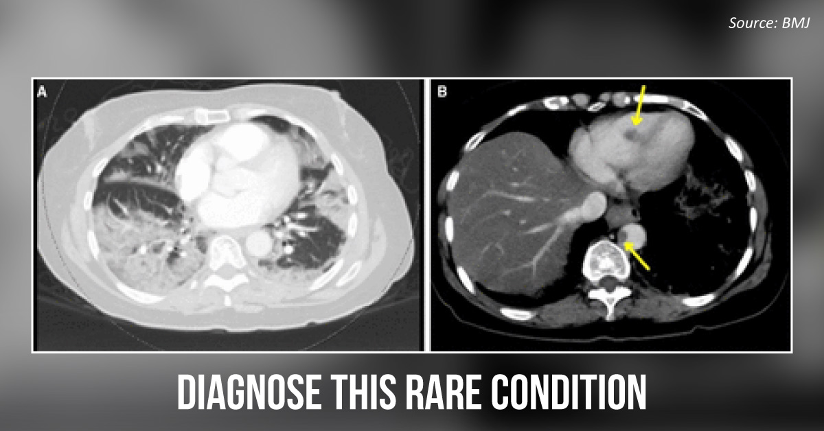 Case of Cardiac Abnormality in a Patient with Severe COVID-19