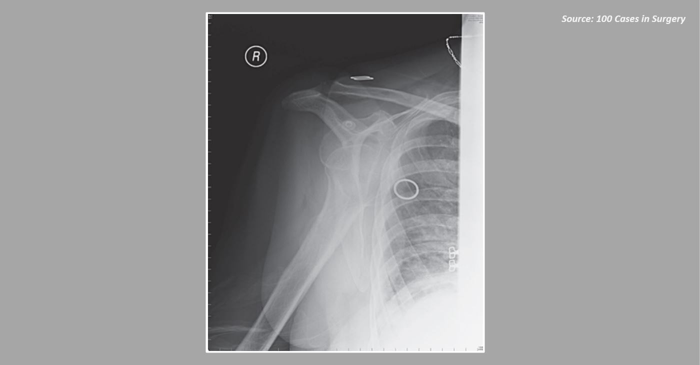 A Case of Right Shoulder Injury - How Will You Manage It?