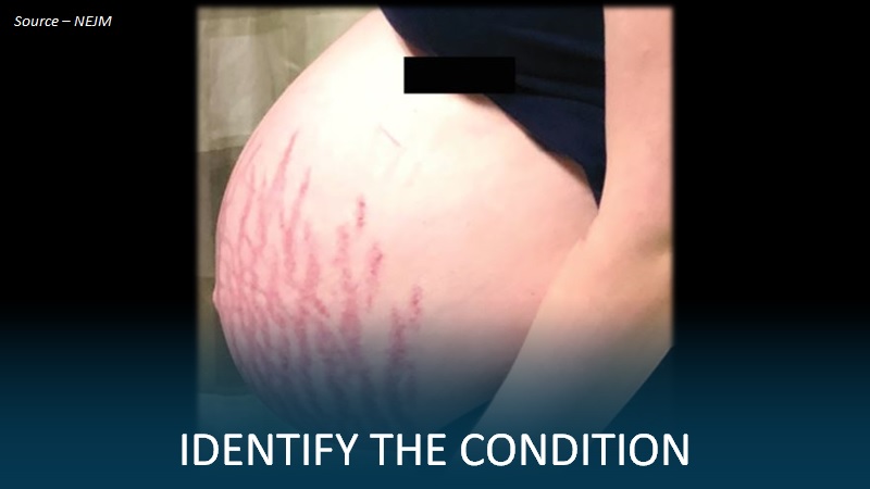 Identify the Reason Behind Striae in This Primigravid Woman