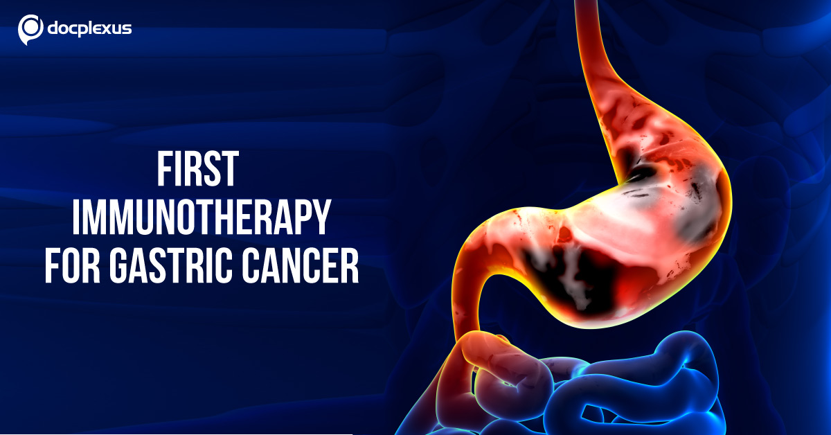 Nivolumab: First Immunotherapy for Gastric Cancer