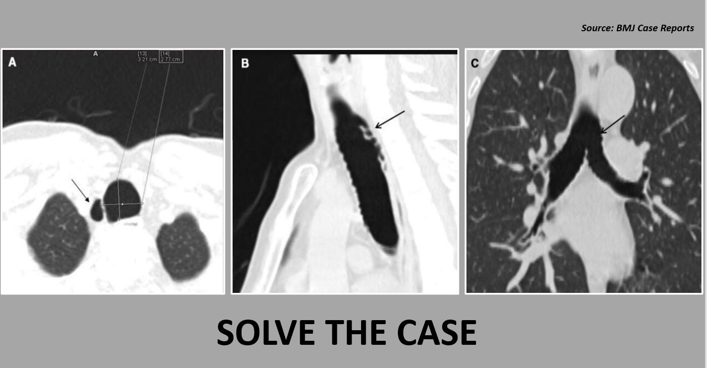 A Case of Recurrent Episodes of Throat Discomfort – What’s Your Diagnosis?