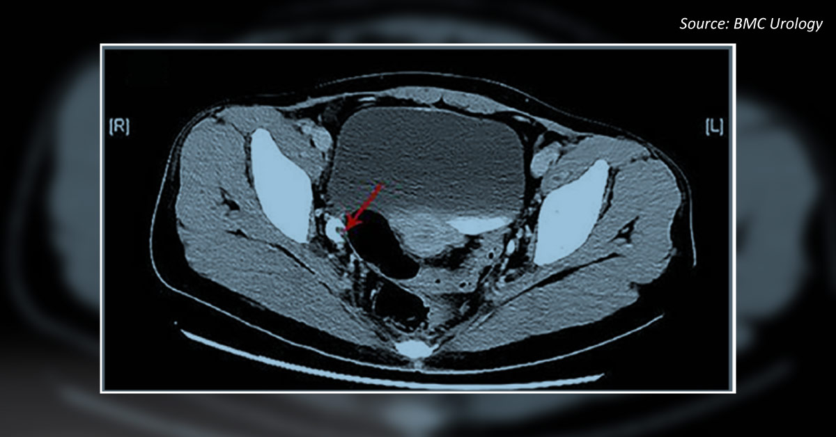 Case of a Patient with Intermittent Hematuria with Dysuria
