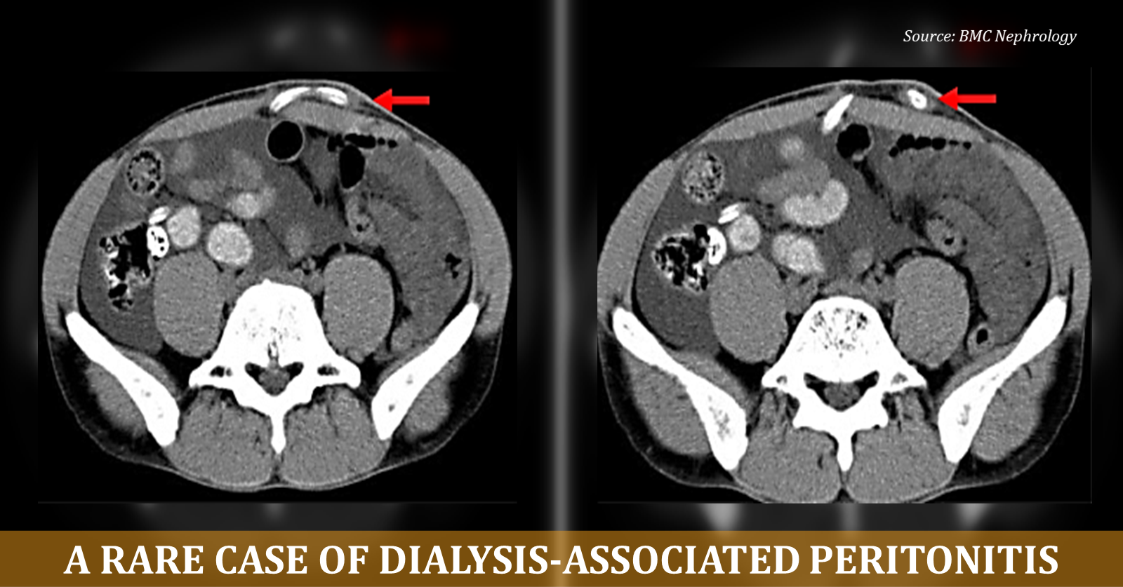 Suggest the Most Appropriate Treatment for Peritoneal Dialysis-associated Peritonitis