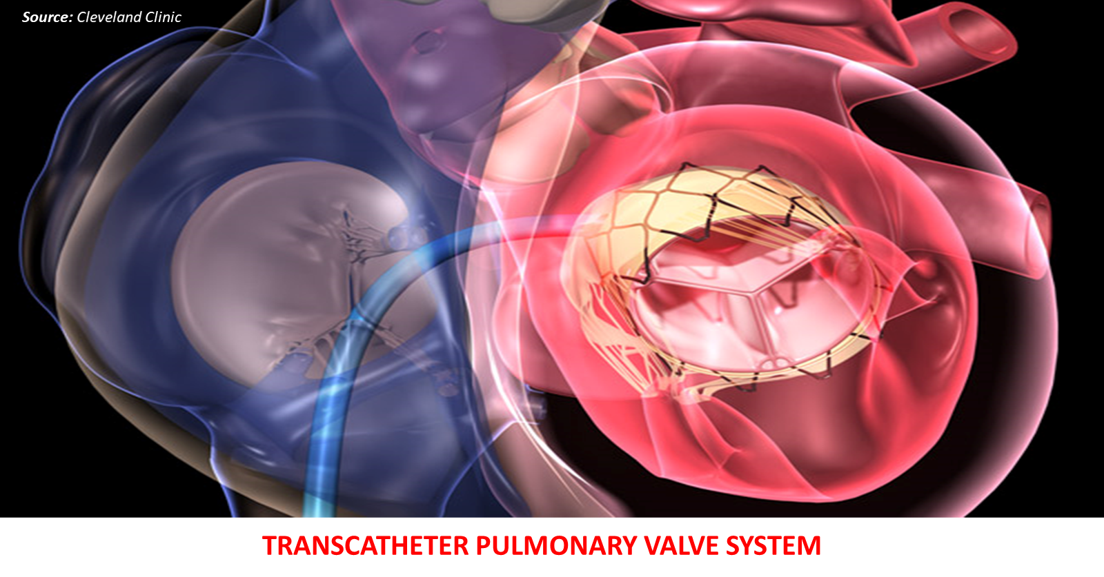 A Unique Device to Treat Patients with Congenital Heart Disease