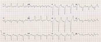 Dizziness and CAD