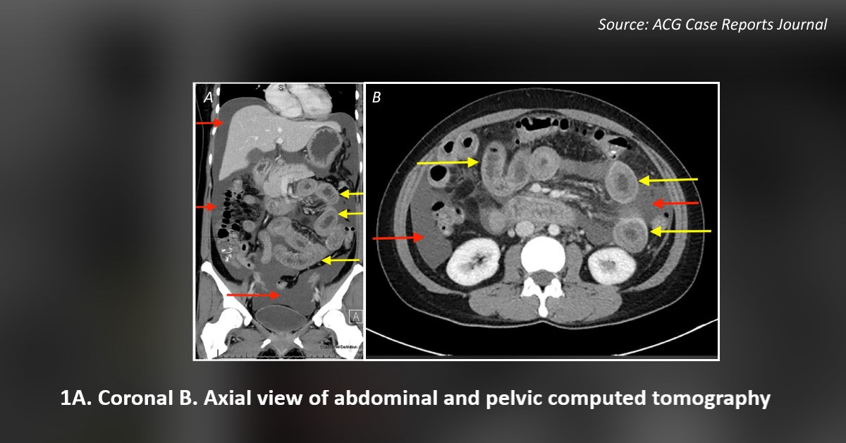 Diagnose This Case of Acute Gastroenteric Disease