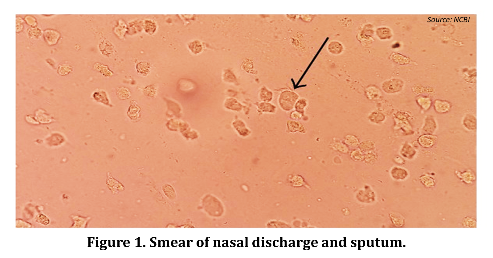Identify the Pathogen Causing Sinusitis and Upper Respiratory Tract Infection