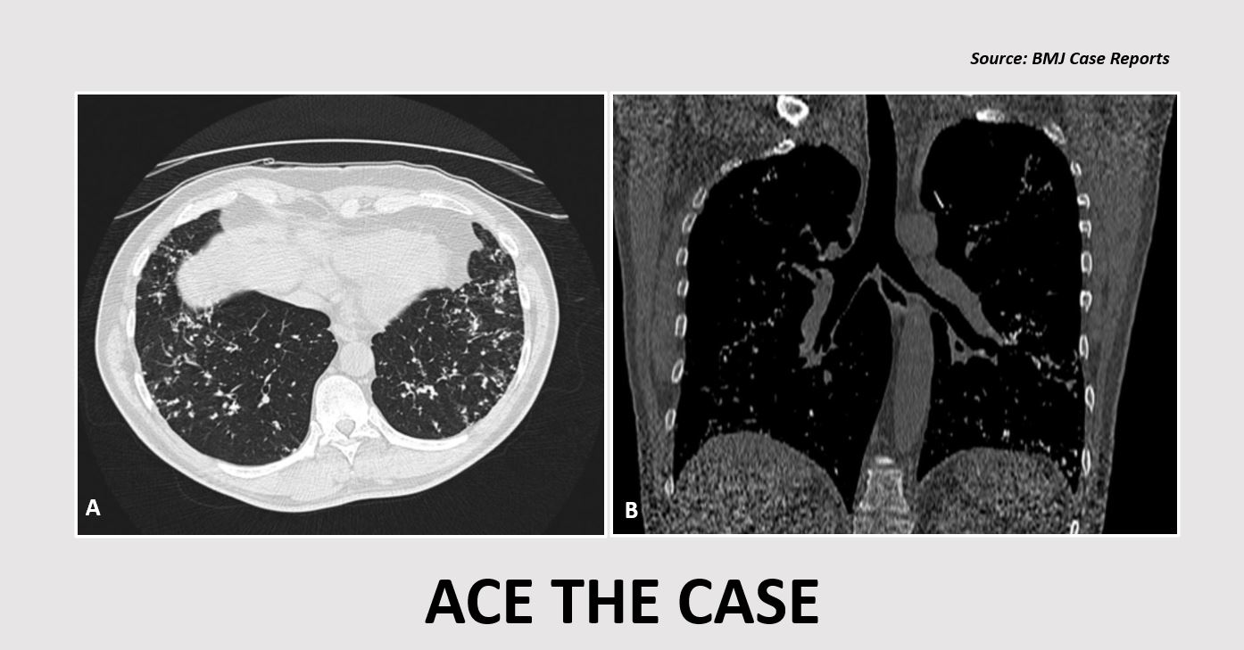 Identify the Reason Behind the Abnormal Chest X-Ray Findings