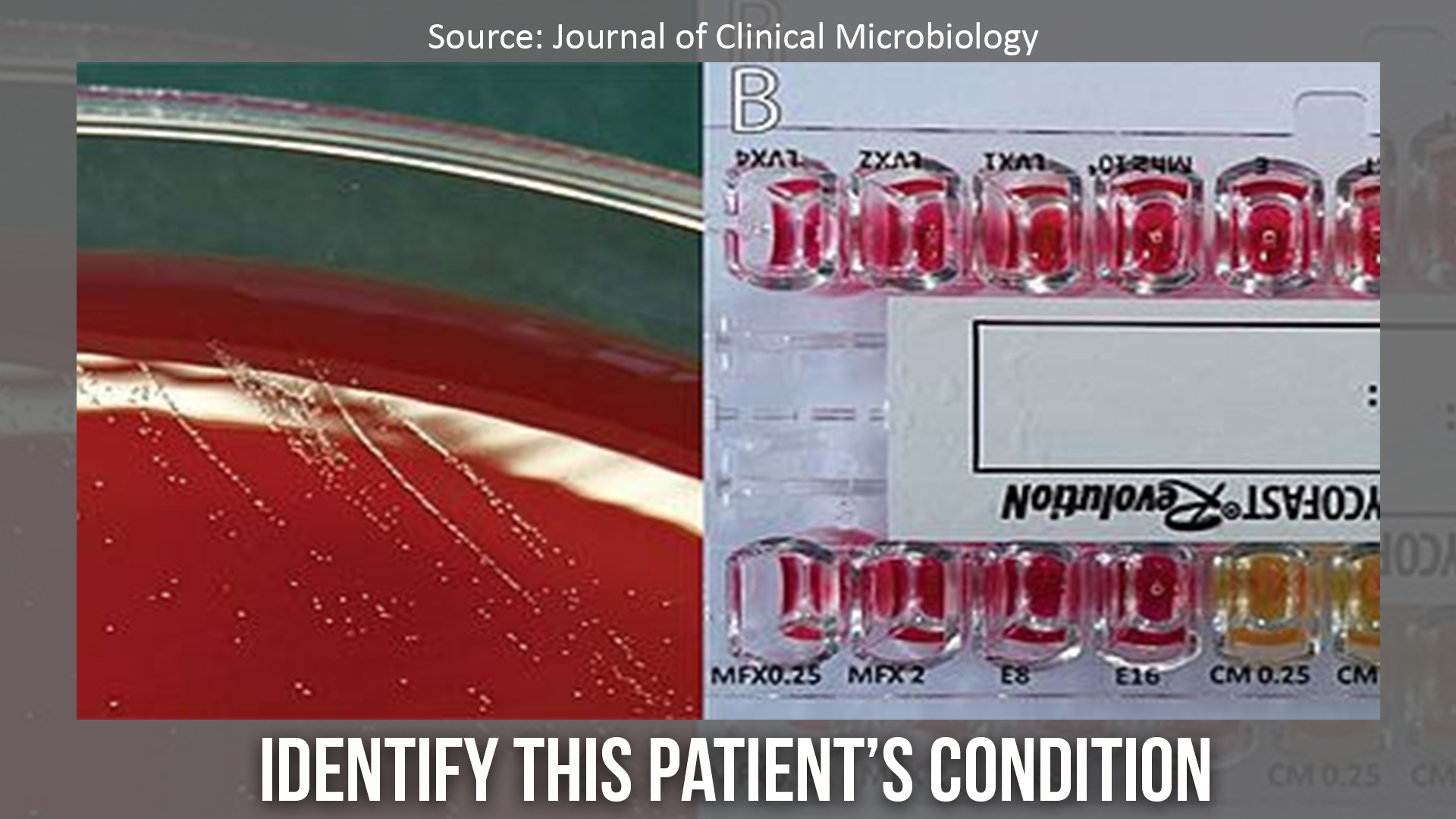 What’s your Diagnosis for this Patient with a History of Rectal Bleeding