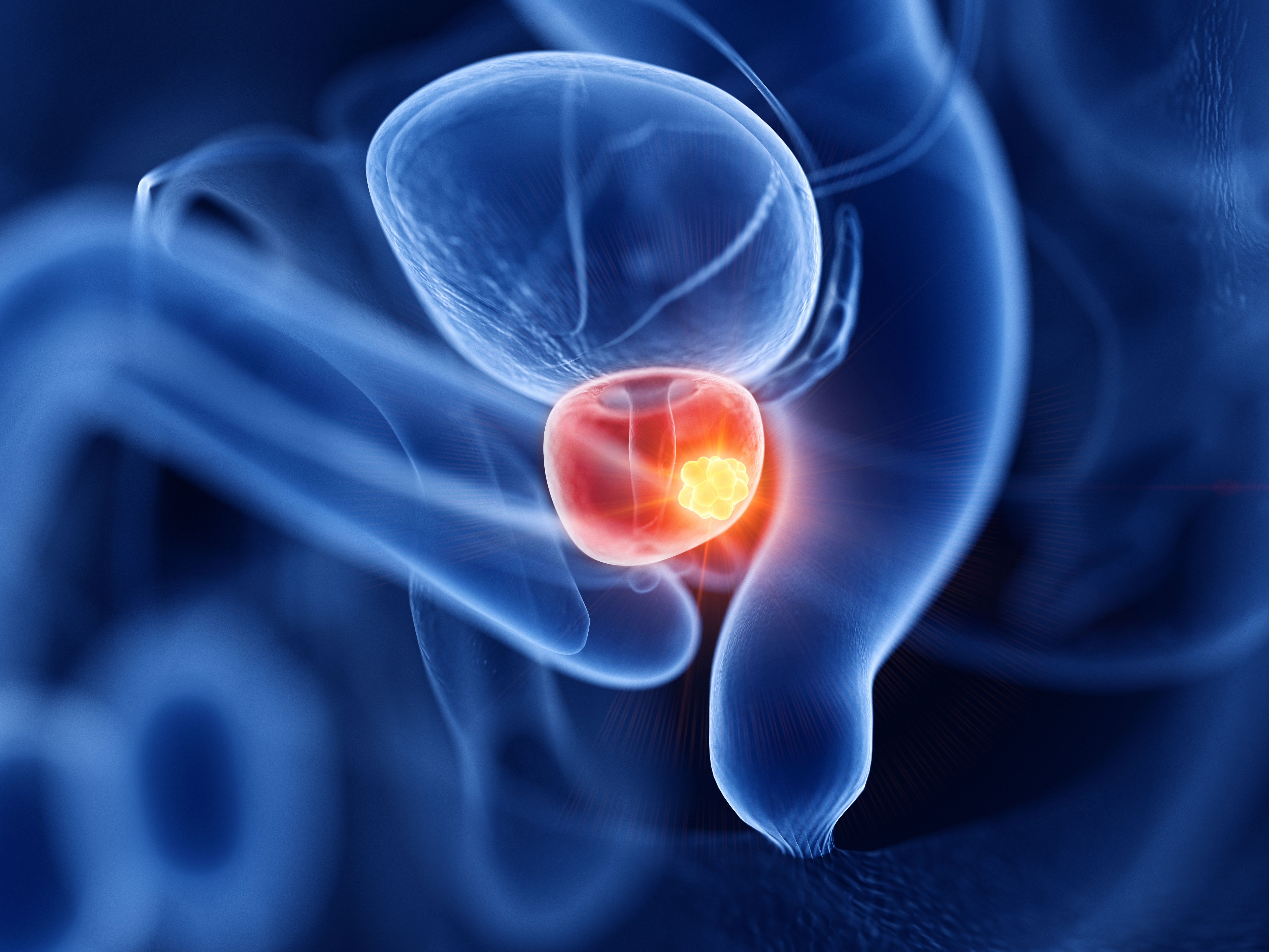 Answer This Question on Prostate Cancer Surgery
