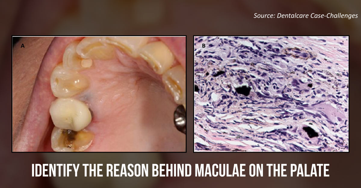 Case of a Female with Blue-Gray Maculae on the Palate