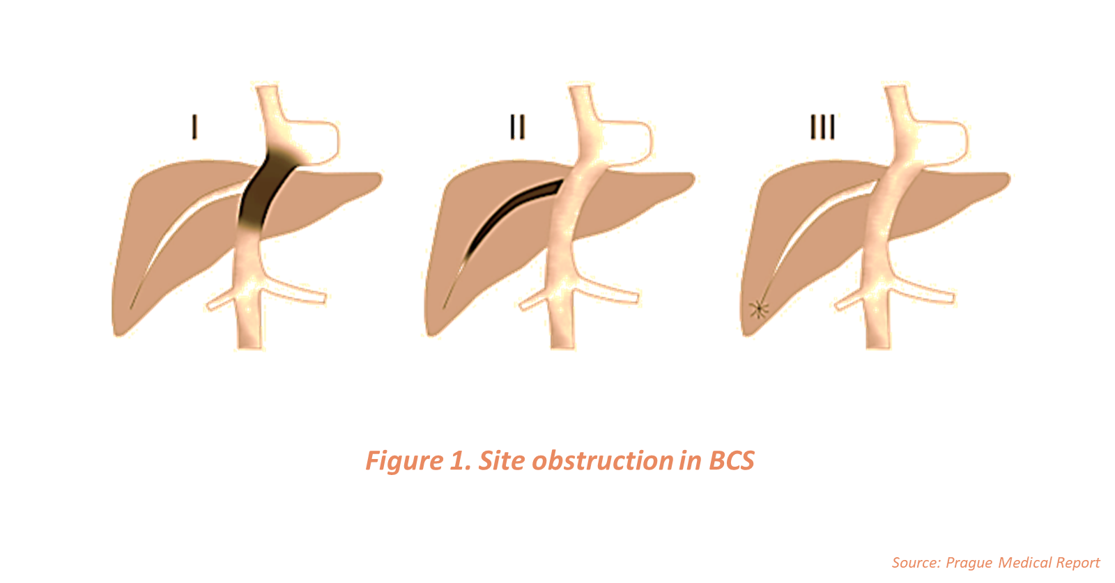 Budd-Chiari Syndrome