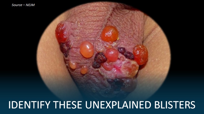 Identify the Reason Behind These Blisters