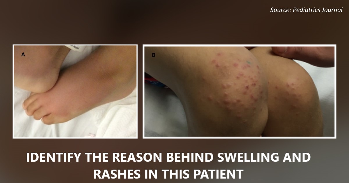 Diagnose This Pediatric Case of Erythematous Swelling and Rash