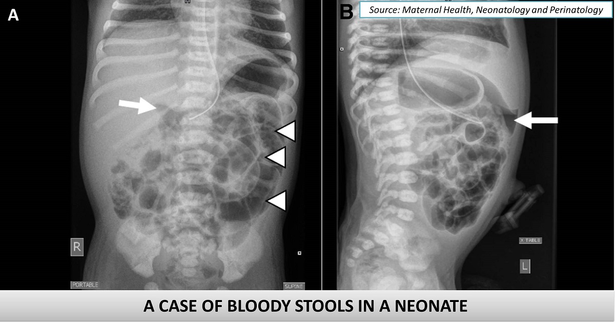 Identify the Reason Behind Bloody Stools in This Neonate