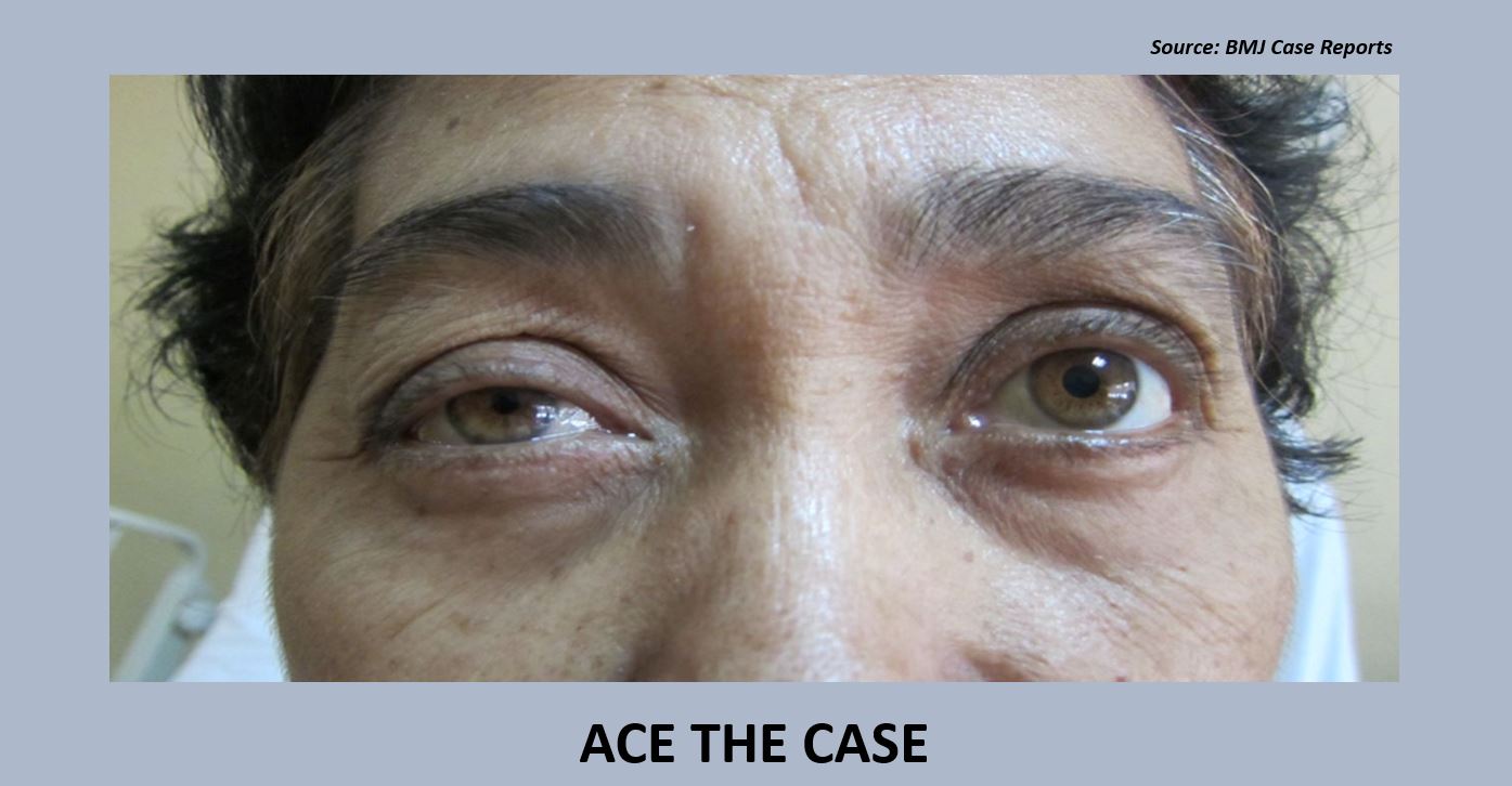 Identify the Reason Behind Ptosis and Miosis of the Right Eye