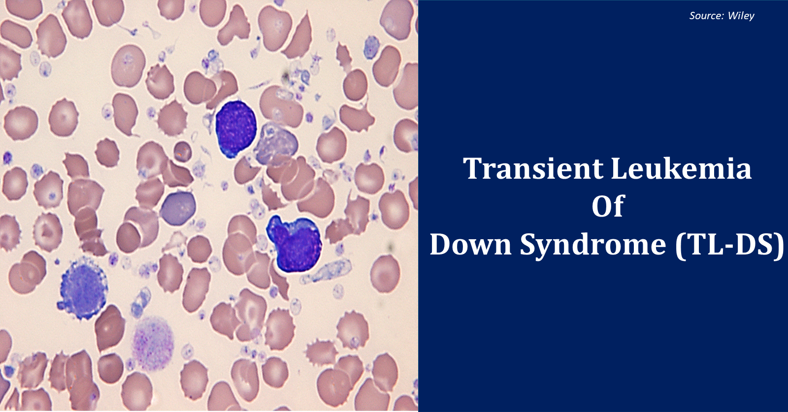Do you know the Gene Mutation Responsible for TL-DS?