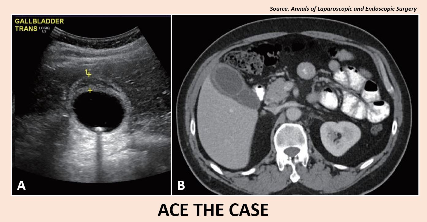 Identify the Reason Behind a Milky-white Drain Fluid in This Patient