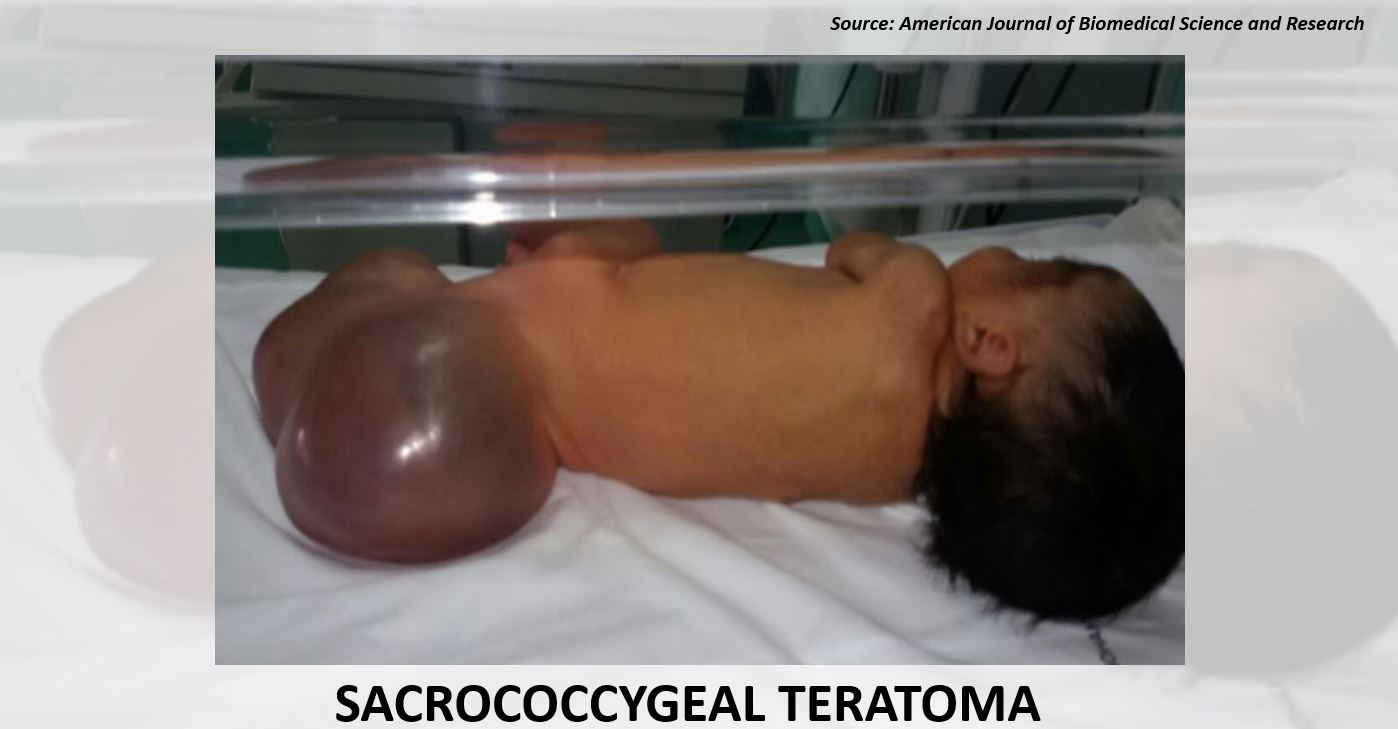 An Overview of Sacrococcygeal Teratoma